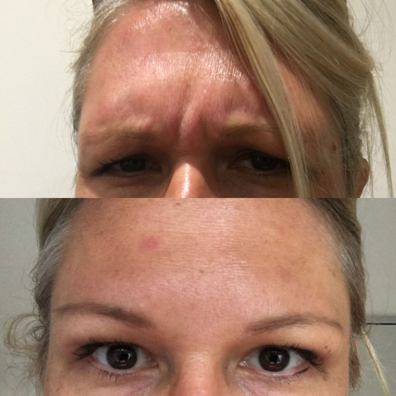 anti-wrinkle injections frown lines