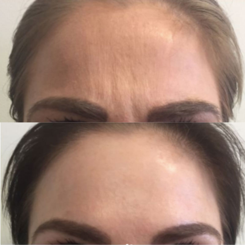 anti-wrinkle injections into frown lines