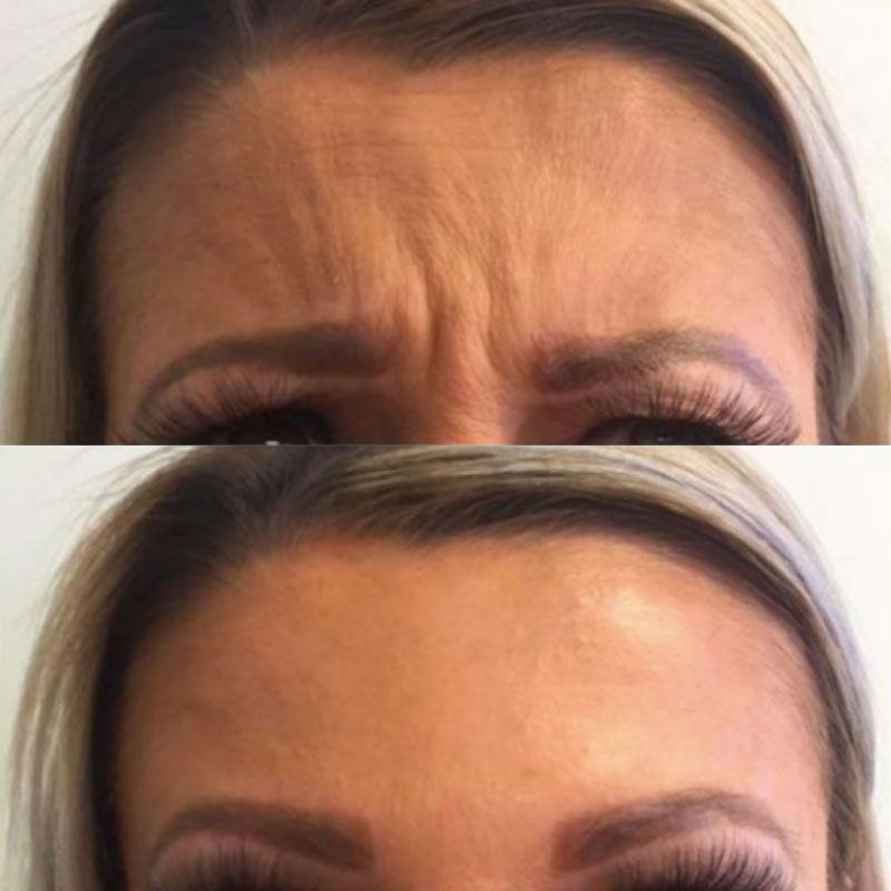 anti-wrinkle injections