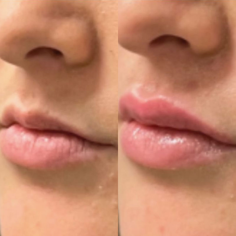 dermal filler for fuller and more symmetrical lips